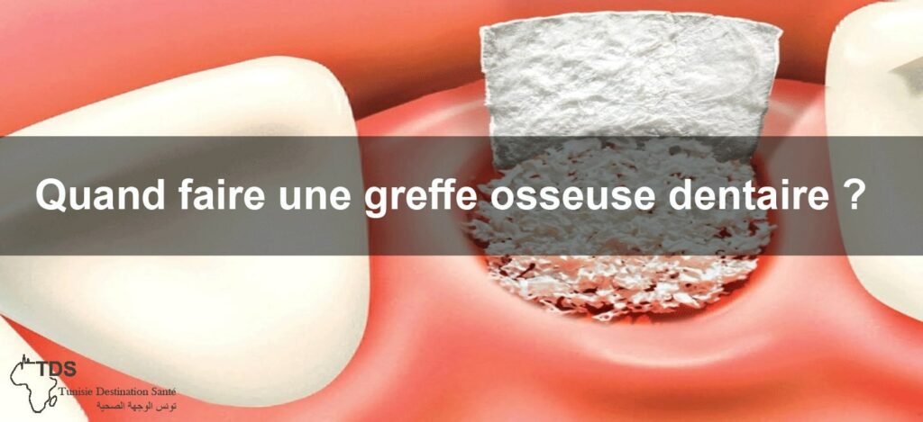 Greffe osseuse dentaire Moment idéal et procédure expliquée