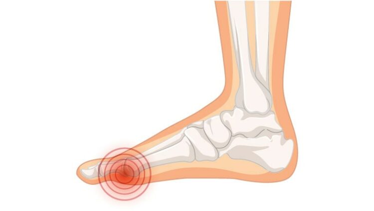 Hallux Valgus Oignon Causes Traitements