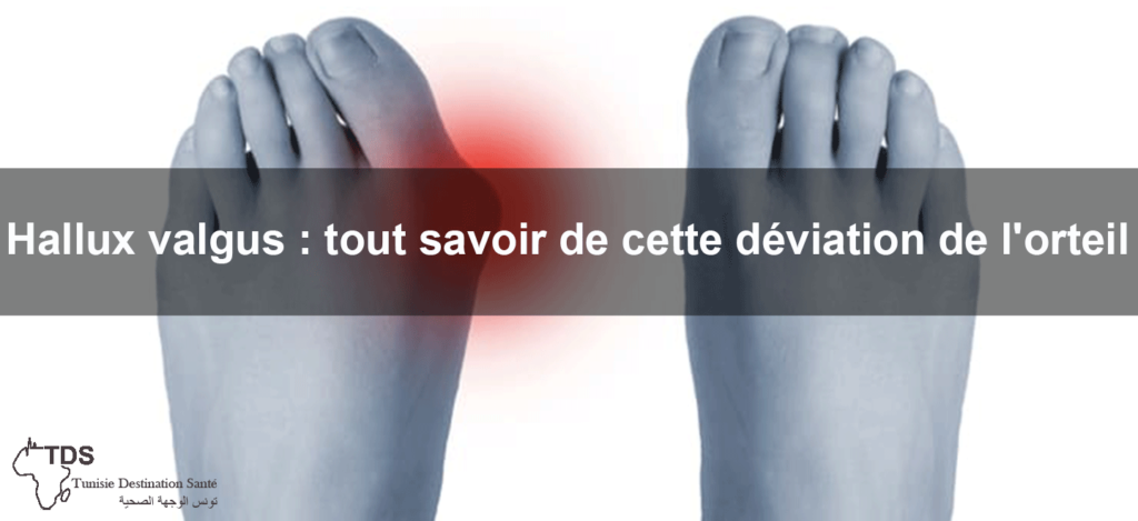 Hallux Valgus Oignon Au Pied Sympt Mes Causes Et Volution