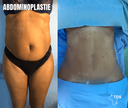 Abdominoplastie Proc Dure R Cup Ration Et R Sultats