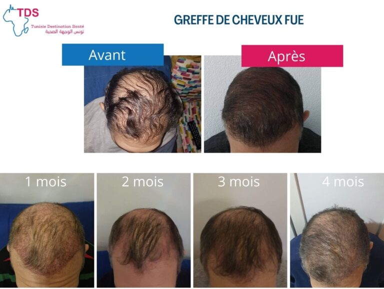 Greffe de cheveux: repousse capillaire mois par mois