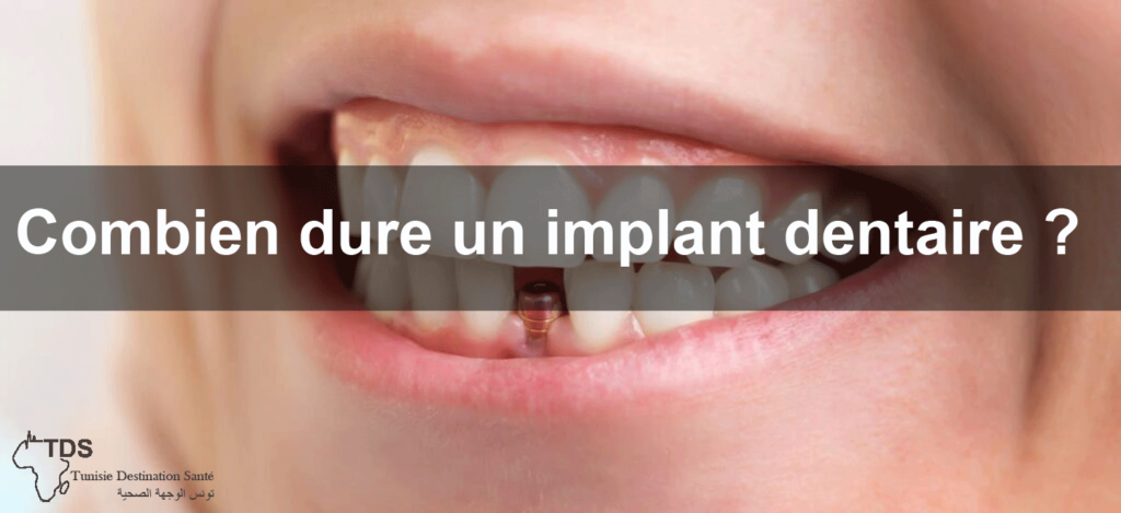 Durée de vie des implants dentaires : ce que vous devez savoir