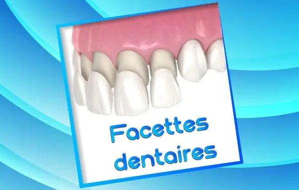 facettes dentaire