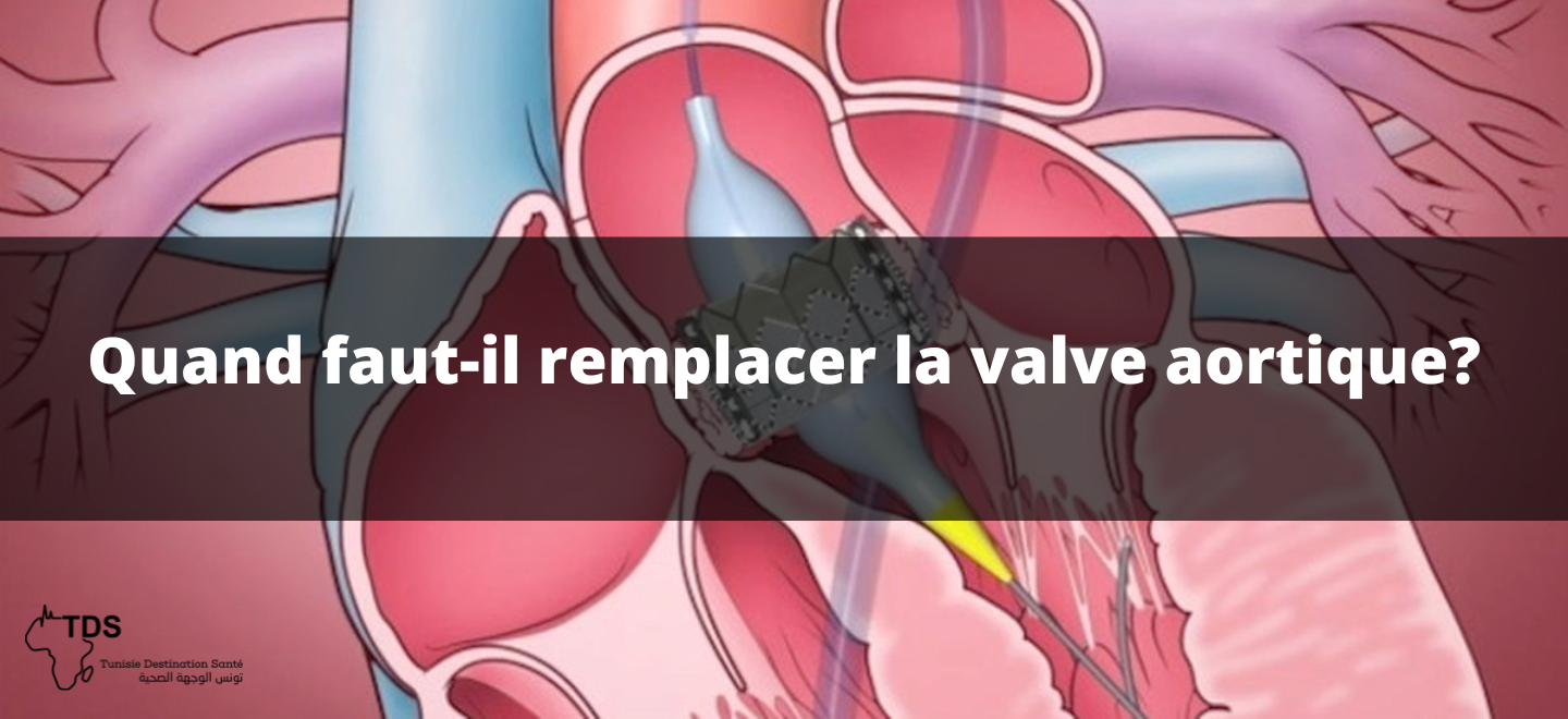 Remplacement valve aortique : Quand faut-il le faire ?