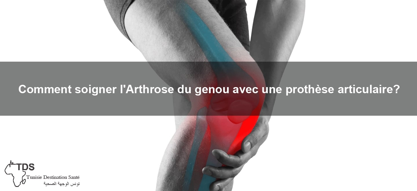 Comment soulager l'arthrose du genou?