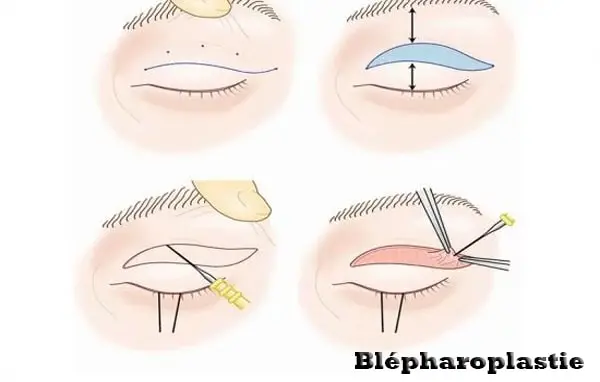 Blépharoplastie