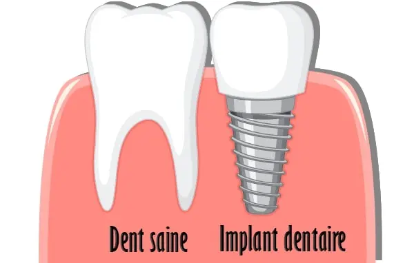 Implants Dentaires