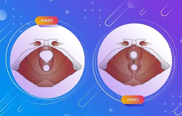 Syndrome de relâchement vaginal
