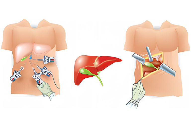 chirurgie hépatobiliaire