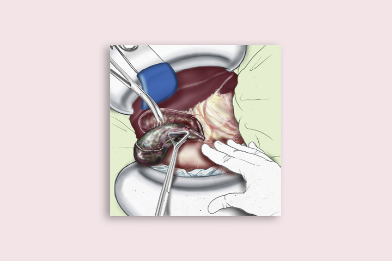 chirurgie hépatobiliaire