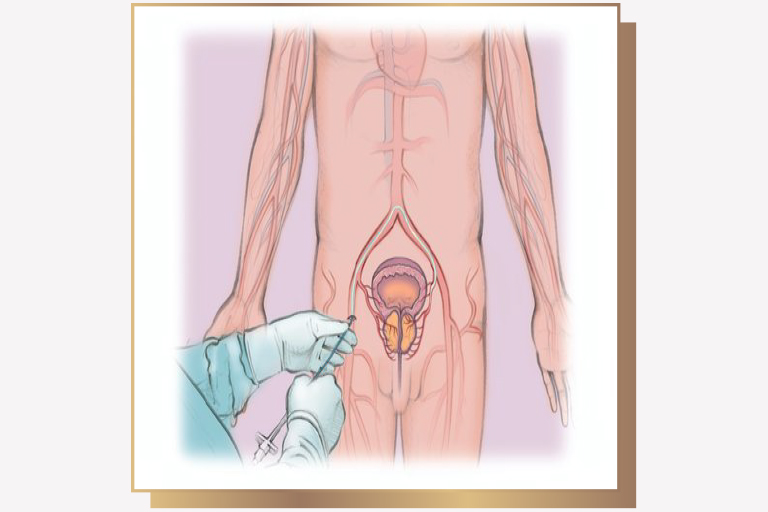 Embolisation prostate