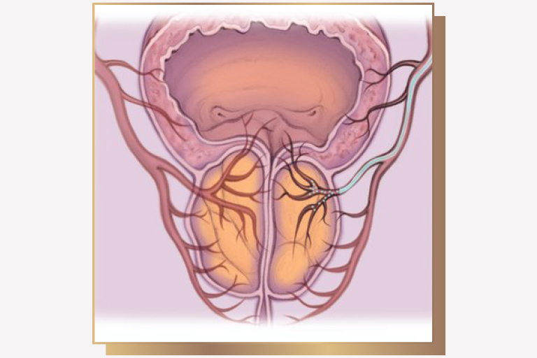 Embolisation prostate