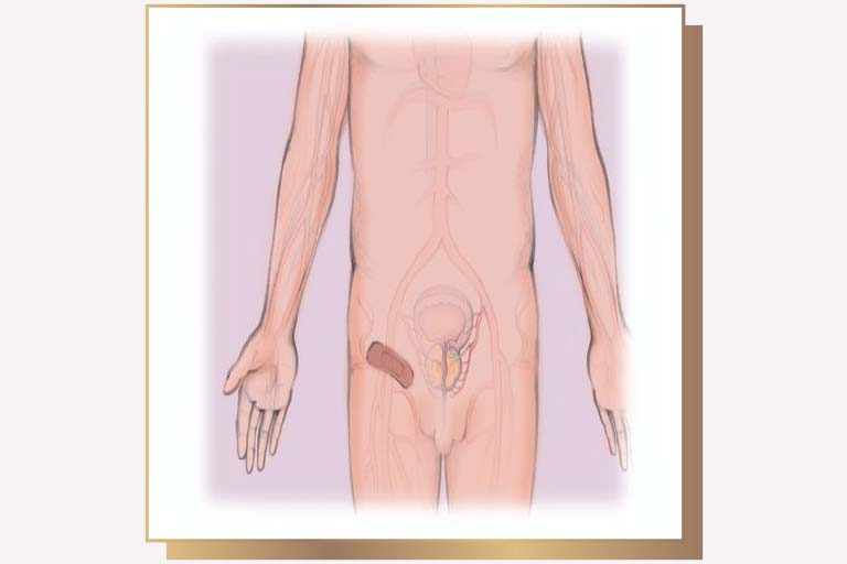 Embolisation prostate