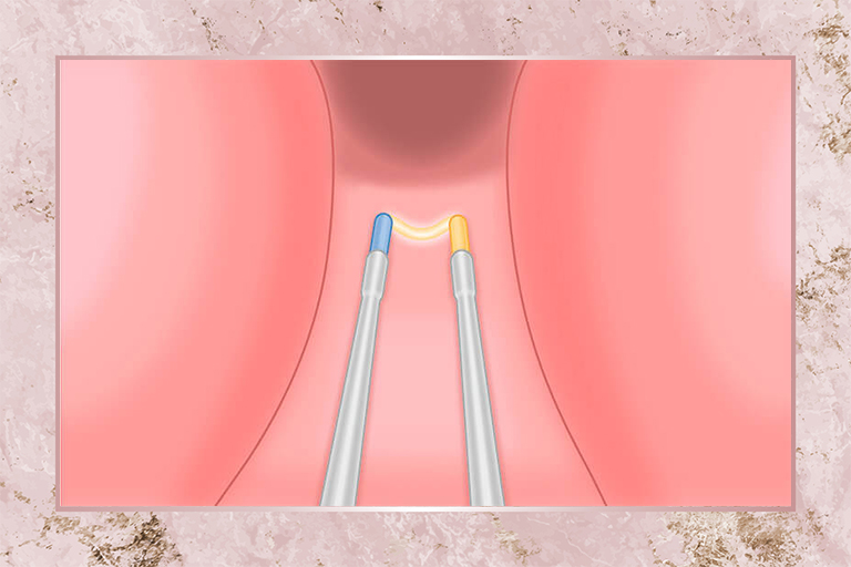 Enucléation prostatique au plasma