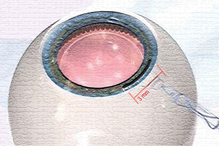 lentille intraoculaire