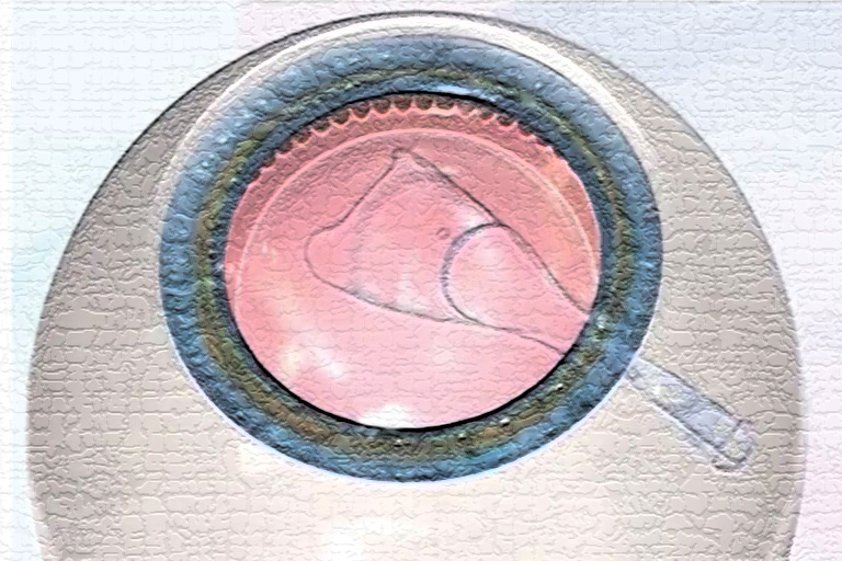lentille intraoculaire