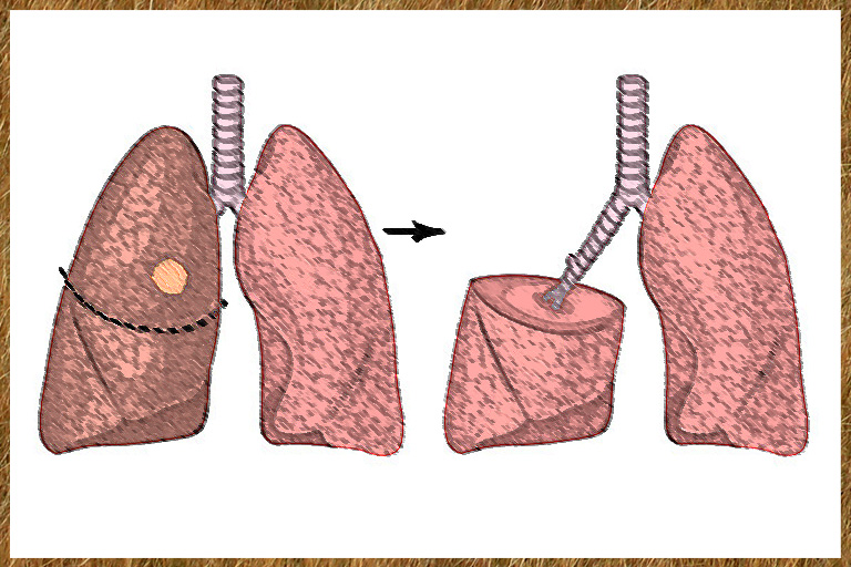 Lobectomie pulmonaire
