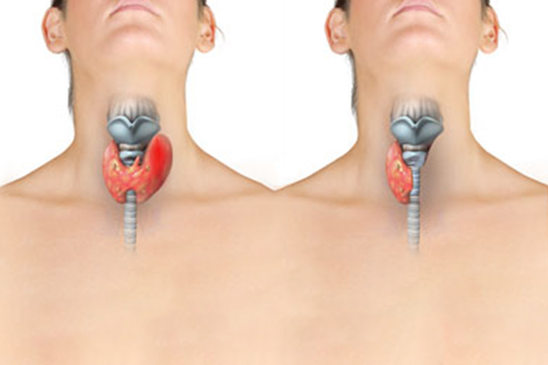 chirurgie de la thyroide