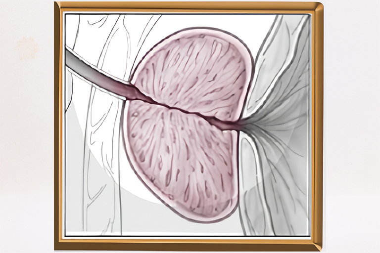 Résection-vaporisation de la prostate