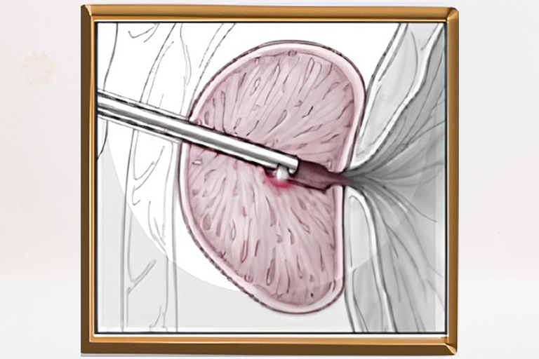 Résection-vaporisation de la prostate