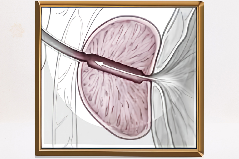 Résection-vaporisation de la prostate