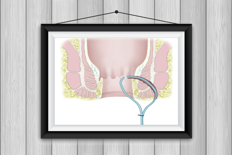 fistules anales