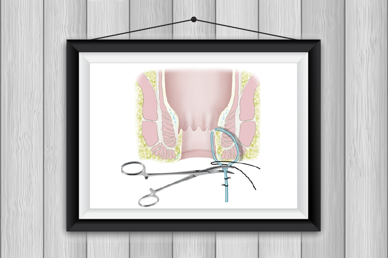 fistules anales