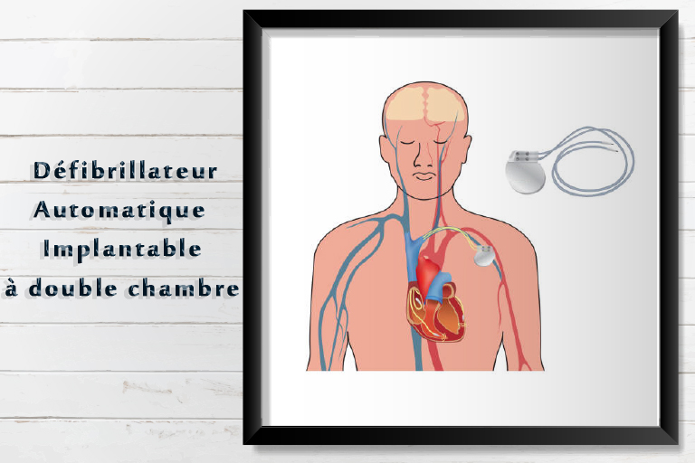 défibrillateur automatique implantable