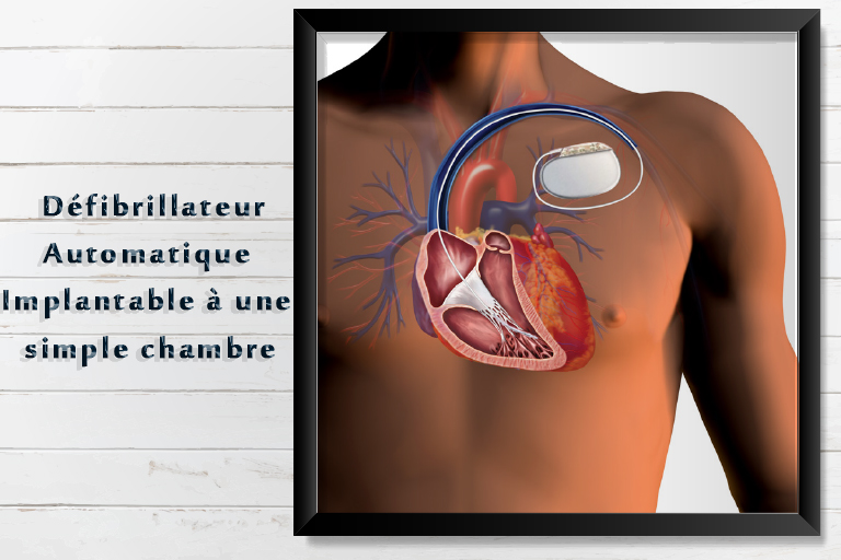 défibrillateur automatique implantable