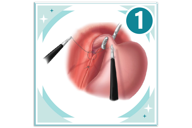 Fundoplicature