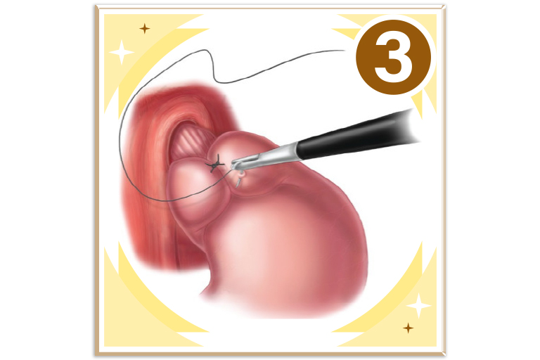 Fundoplicature