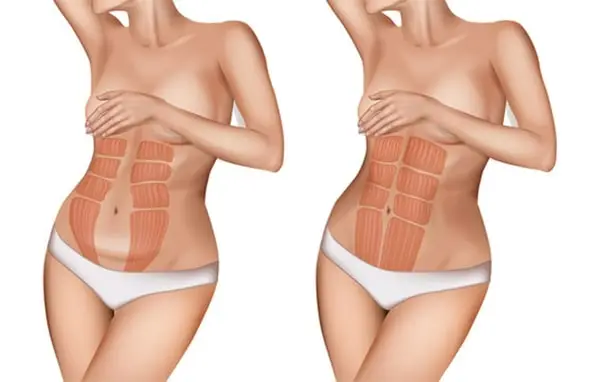 abdominoplastie