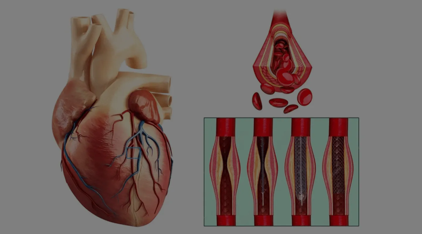 Angioplastie