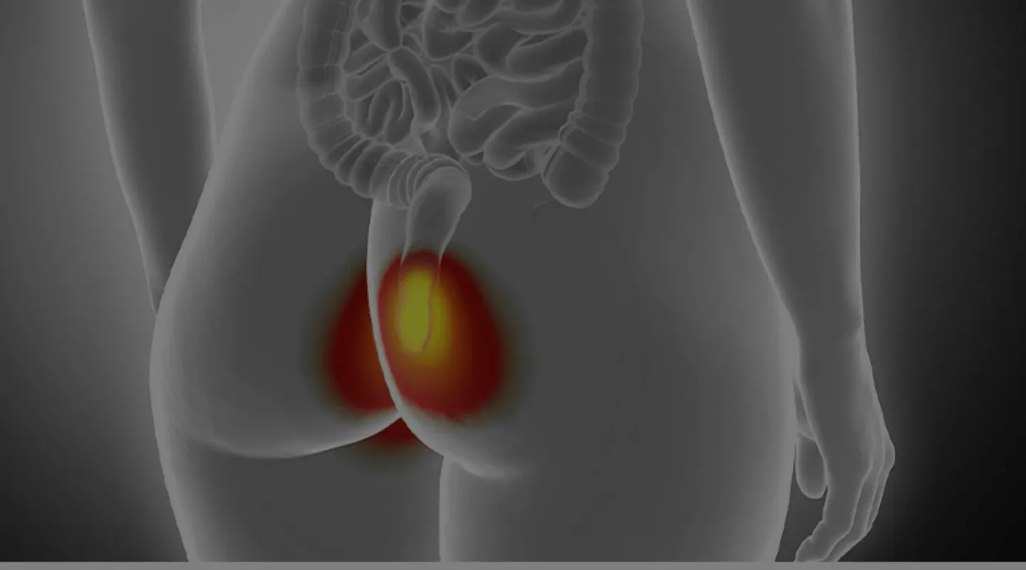Chirurgie proctologique