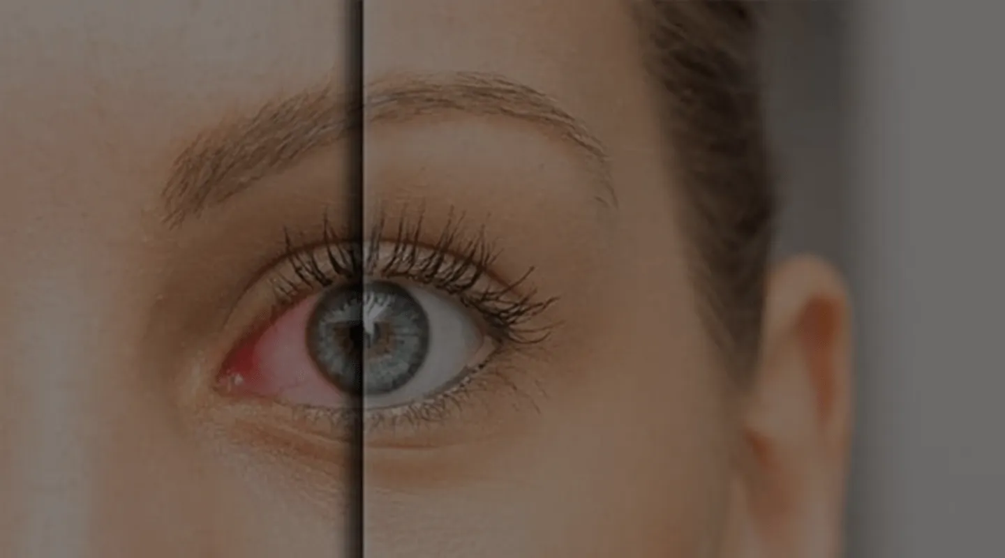 Chirurgie du Glaucome