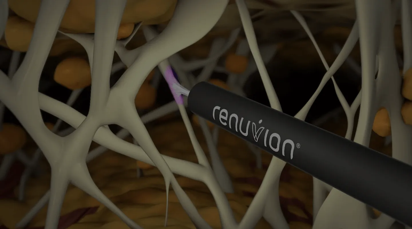 Renuvion J Plasma