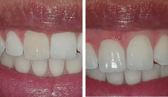 Traitement dent dévitalisée