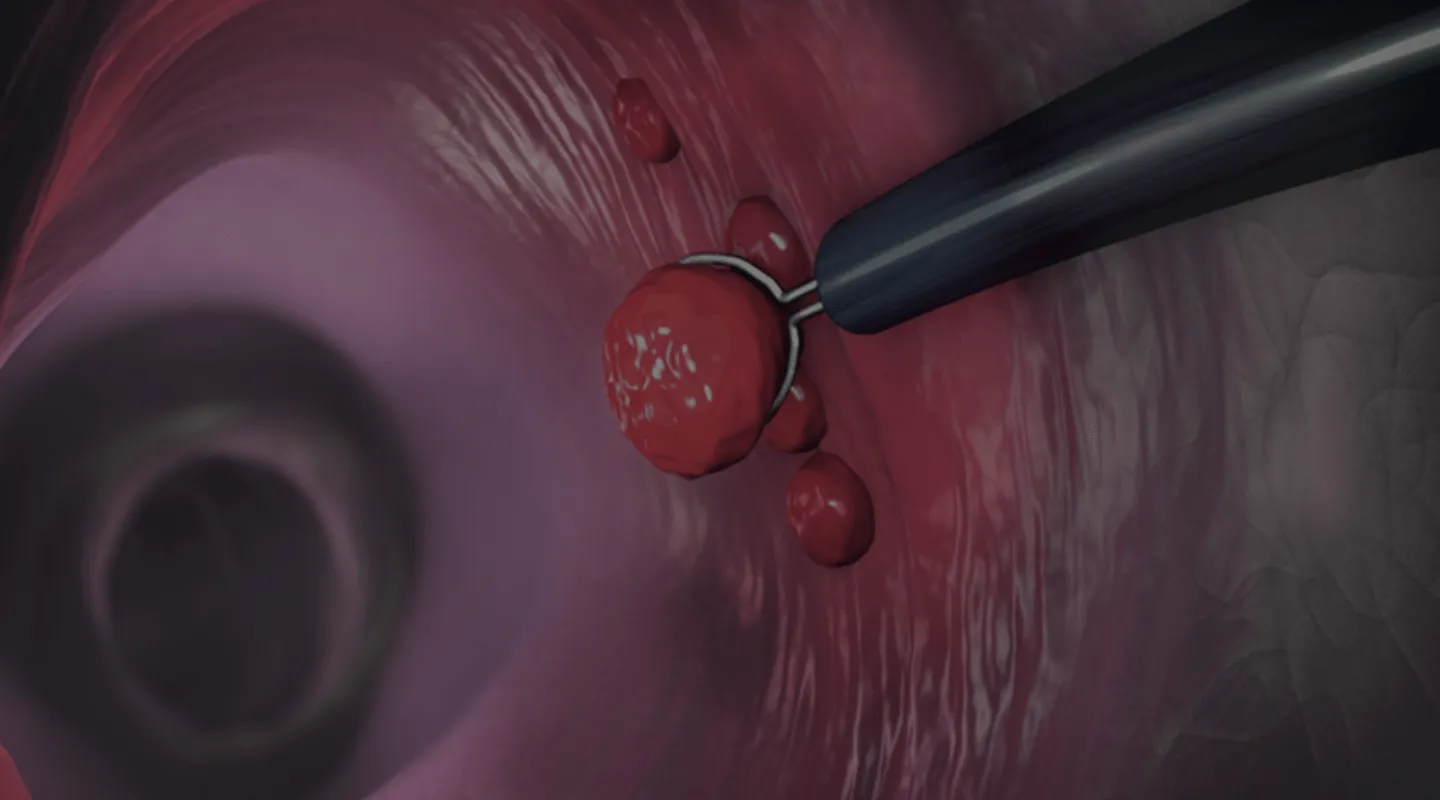 Chirurgie des polypes