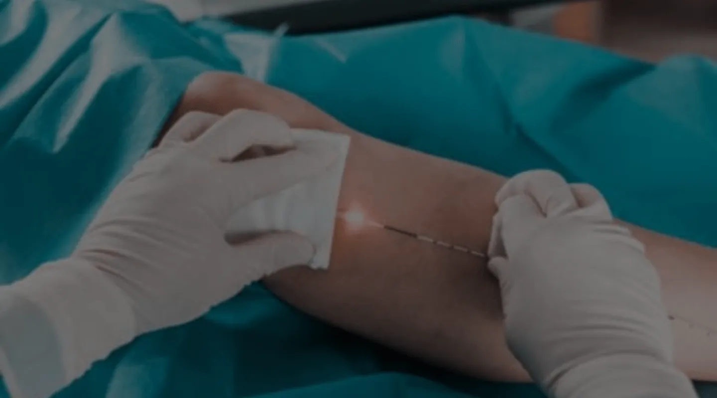 FAQ Laser Endoveineux