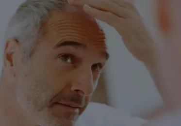FAQ Greffe de Cheveux