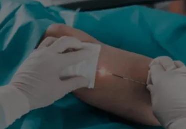 FAQ Laser Endoveineux